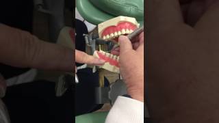 Instrumentation on Mandible with Universal Curettes part 1 [upl. by Pompei150]