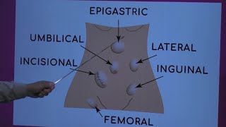 Types of Hernia [upl. by Lonyer]