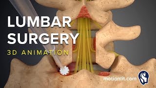 Lumbar Surgery  Laminectomy  3D Medical Animation [upl. by Nagrom]