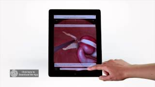 Touch Surgery Simulation  Laparoscopic Appendectomy [upl. by Nyliahs]