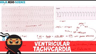 Atrial Fibrillation Afib  EKG ECG Interpretation [upl. by Salangia415]