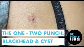 The OneTwo Punch Blackhead amp Cyst [upl. by Neurath592]