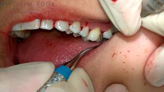 Gracey Instrumentation During Periodontal Therapy [upl. by Ronyam85]