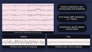 Ventricular Fibrillation ECG [upl. by Sirromed]