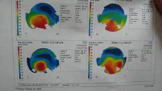 Corneal topography explained [upl. by Rochella]