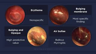 Acute Otitis Media Otoscopic Findings [upl. by Oderfodog]