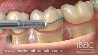 Periodontal disease causes and treatment [upl. by Asteria]