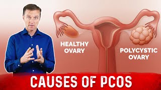 3 Causes of Polycystic Ovarian Syndrome PCOS amp High Androgens – Dr Berg [upl. by Ddahc]