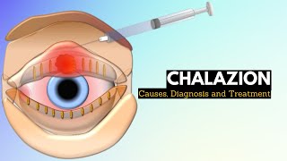 CHALAZION Causes Signs and Symptoms Diagnosis and Treatment [upl. by Peskoff]