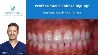 Professionelle Zahnreinigung VorherNachherBilder [upl. by Eirrak]