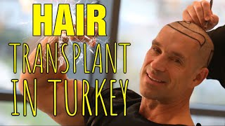 Why I Got A Hair Transplant In Turkey  Full Experience [upl. by Mitzl618]