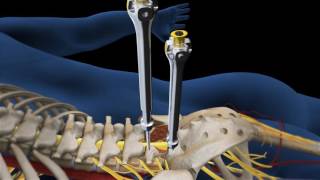 Lumbar Fusion of L5 S1 Animation [upl. by Barnes]