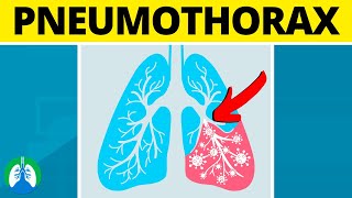 Pneumothorax Medical Definition  Quick Explainer Video [upl. by Ddal]