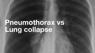 Pneumothorax vs Lung Collapse [upl. by Kitarp465]