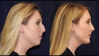 Mini Neck Lift Must See Before After Results [upl. by Yenar326]