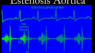 Soplo de la Estenosis Aórtica [upl. by Gilbart]