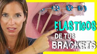 🖍📒ELASTICOS INTERMAXILARES para asentar MORDIDA  Para que sirven las GOMAS de los BRACKETS [upl. by Annoj747]