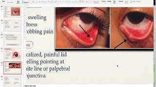 Hordeolum AND CHALAZION [upl. by Tomasine]