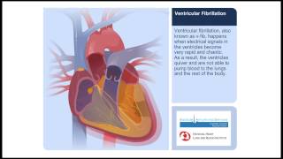 Rate and Rhythm  Ventricular Tachycardia [upl. by Colbye]