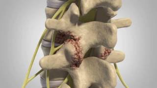 Lumbar Degenerative Disc Disease  Patient Animation [upl. by Fedirko]