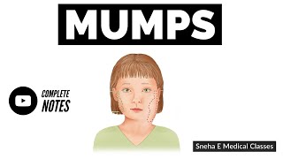 Mumps Symptoms Causes Treatments and Complications [upl. by Ledua775]