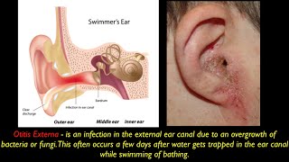 Otitis Externa PEV [upl. by Ynatil18]